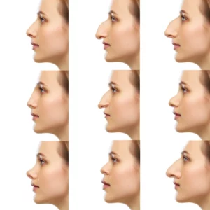 différentes formes de nez rhinoplastie