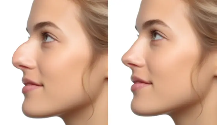 rhinoplastie