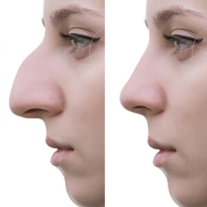 simulateur de rhinoplastie