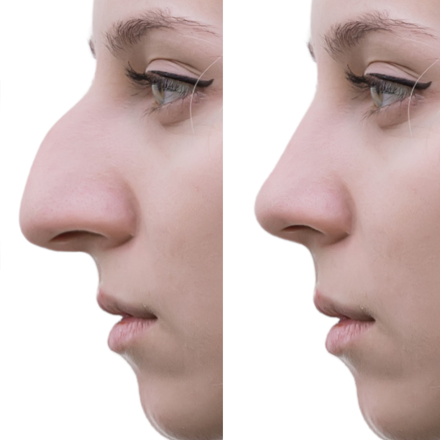simulateur de rhinoplastie