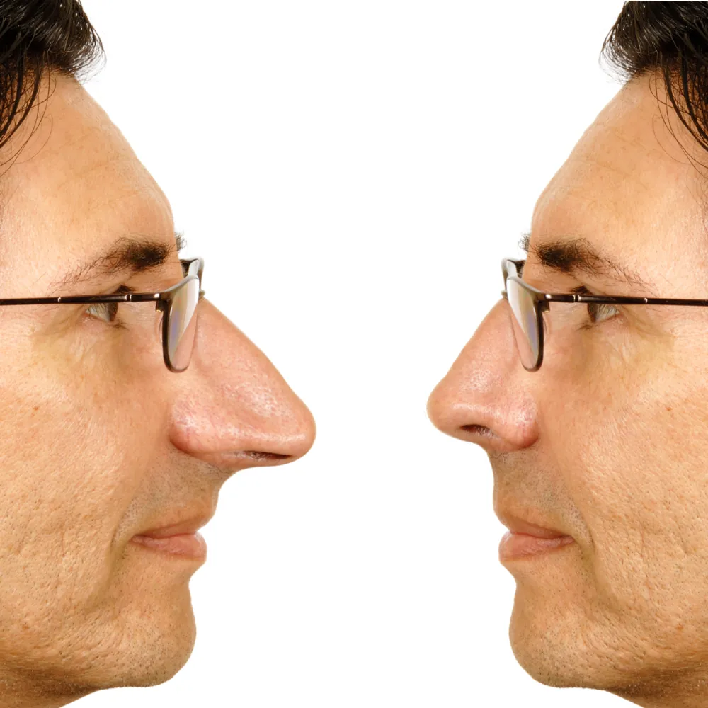 simulateur de rhinoplastie